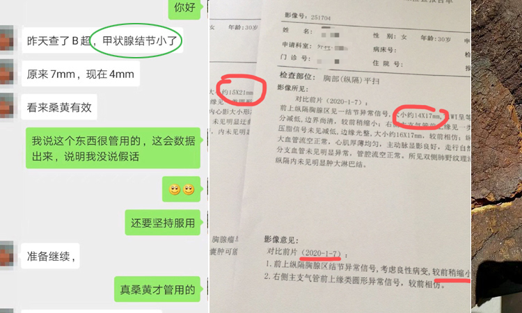 桑黄对甲状腺结节有治疗效果案例